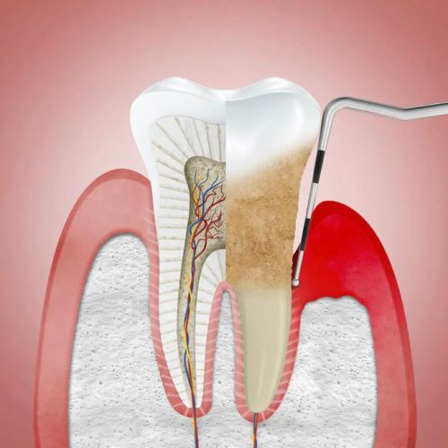 PERIODONTAL THERAPY