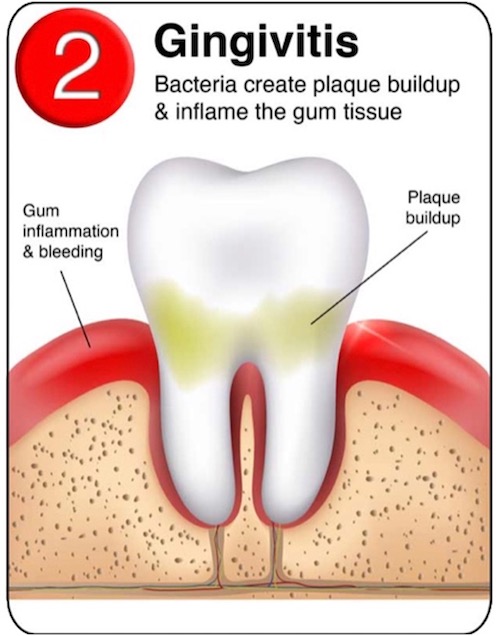 Gum Disease