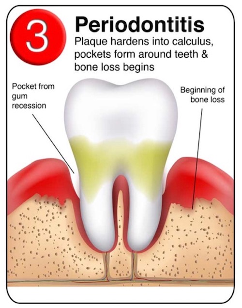 Periodontitis Treatment