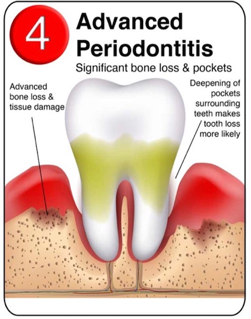Periodontitis Cornwall