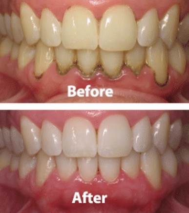 Truro gum disease treatment