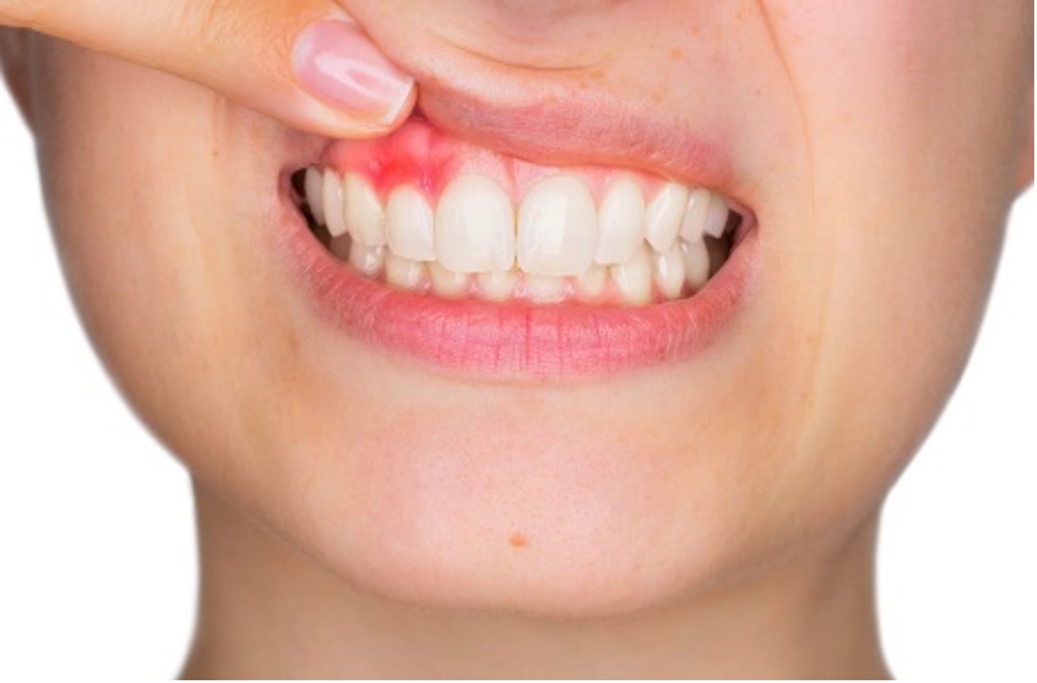 Gum Disease Treatment