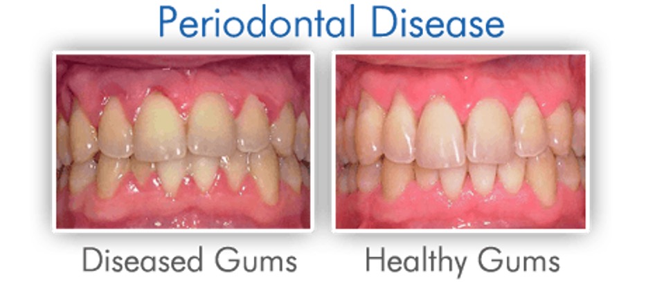 Periodontal Disease Treatment