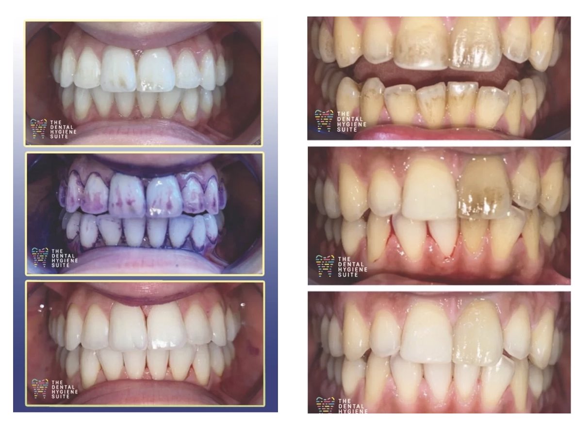EMS Airflow Guided Biofilm Therapy equipment used for dental hygiene cleaning