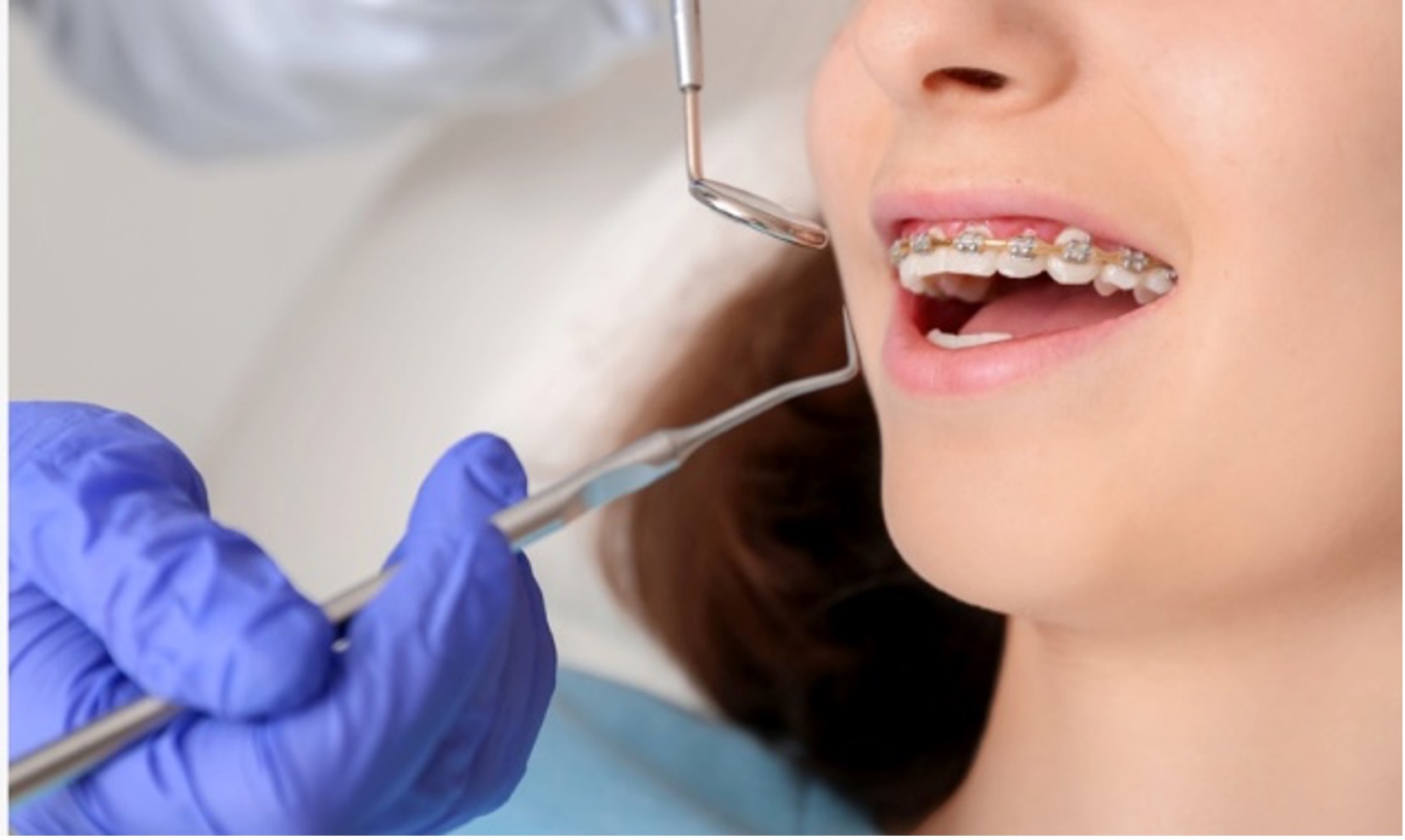 Orthodontic scale and polish treatment for teeth with fixed braces