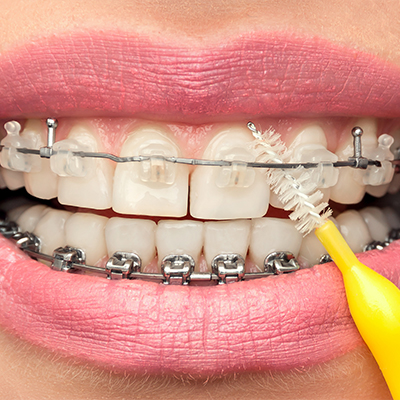 Orthodontic Scale & Polish 