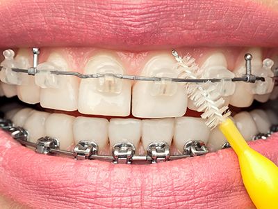 Dental hygienist cleaning around brackets and wires on fixed braces