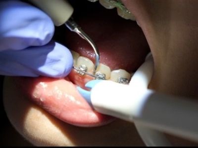 Dental hygienist demonstrating how to clean around orthodontic braces