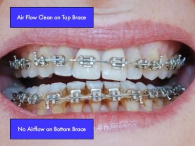 EMS Airflow removing surface staining from teeth with orthodontic braces
