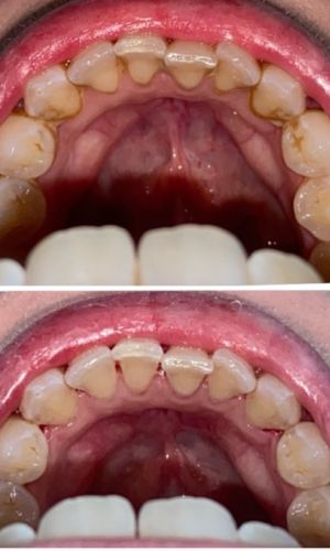 Before and after view of tartar removed from the inside of the upper teeth