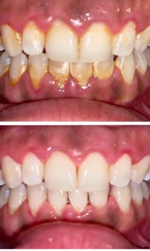 Before and after view showing heavy tartar removed during a dental hygiene appointment