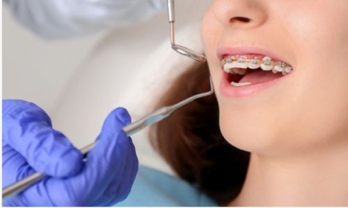 Orthodontic Polish