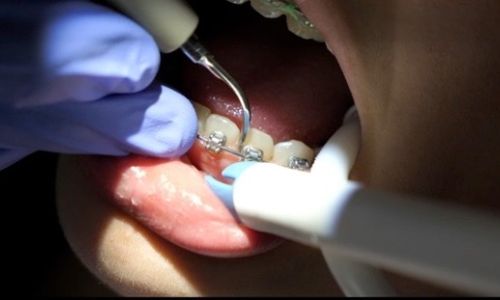 Orthodontic scale