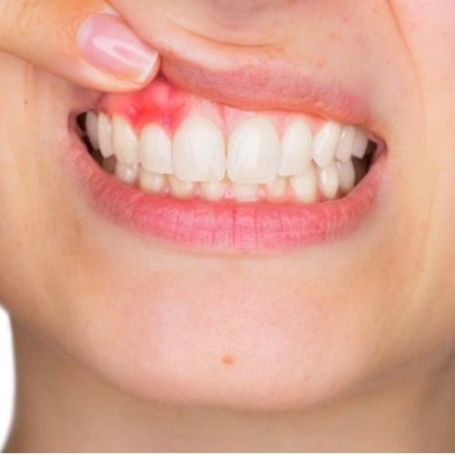Gum Disease