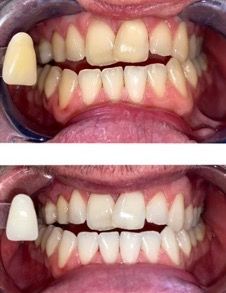 Scale & Polish removing light stains