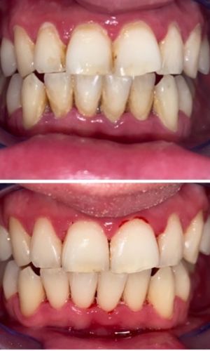 Before and after view of front teeth following a professional scale and polish