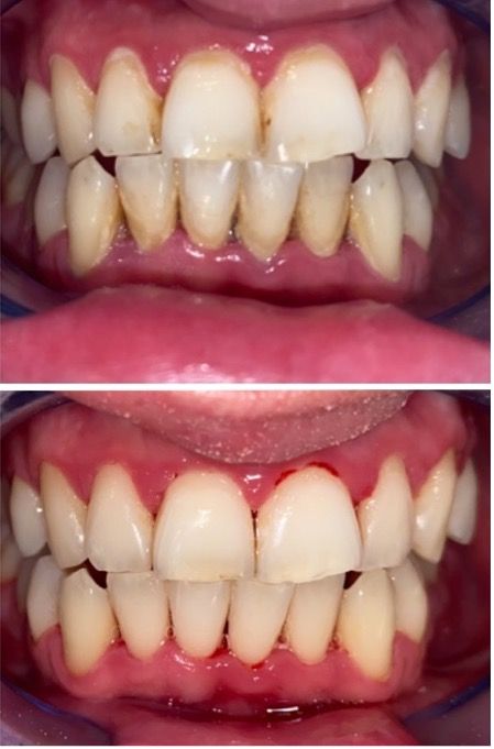 Teeth Scale & Polish Treatments Cornwall