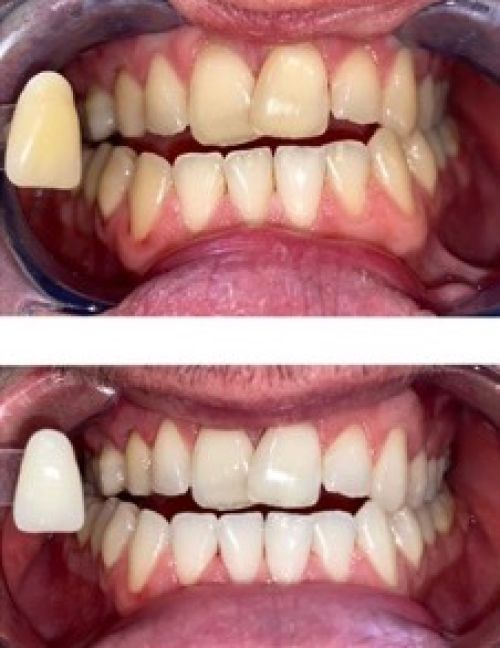 Scale & Polish removing light stains